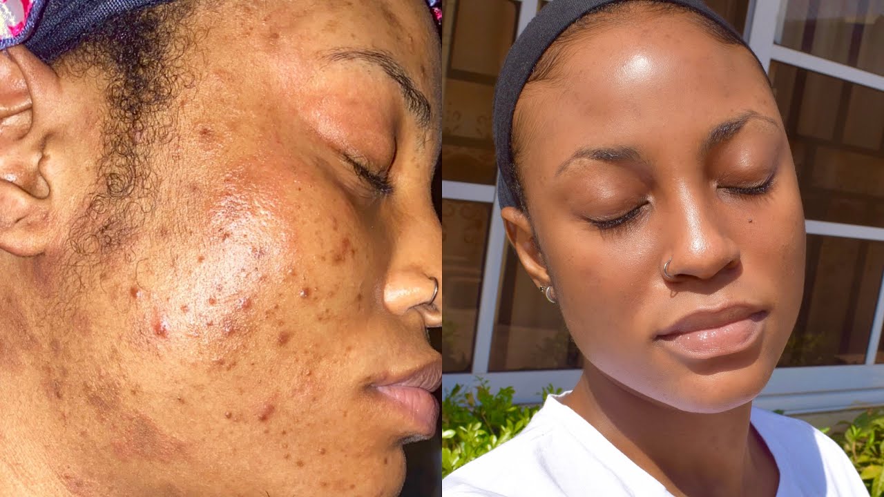 Combo Set for Oily, Acne-Prone Skin