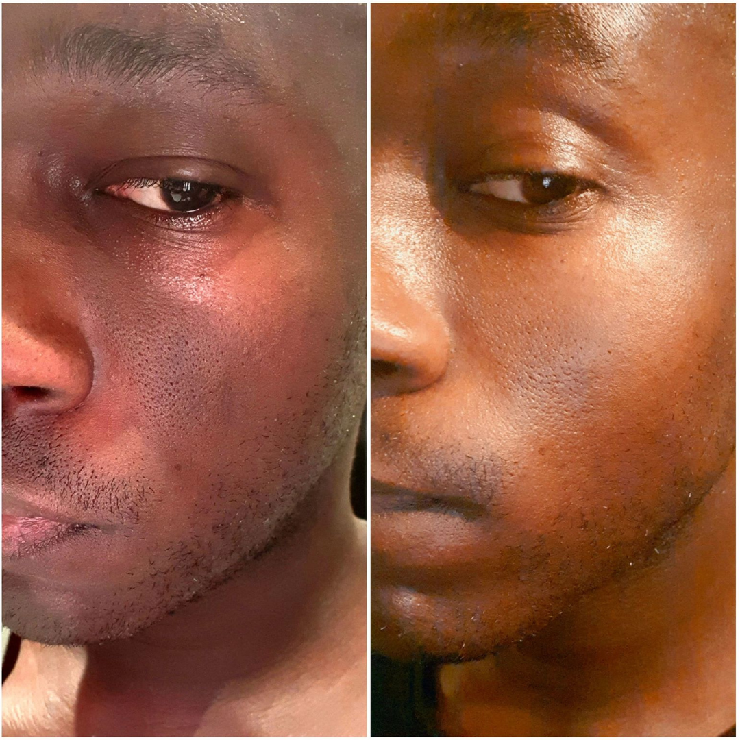 Combo Set – For Melasma, Pigmentation, and Dark Spots Gone!