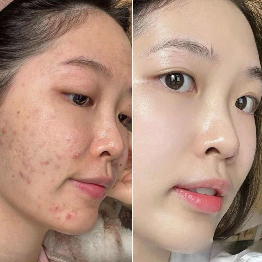 Combo Set for Oily, Acne-Prone Skin