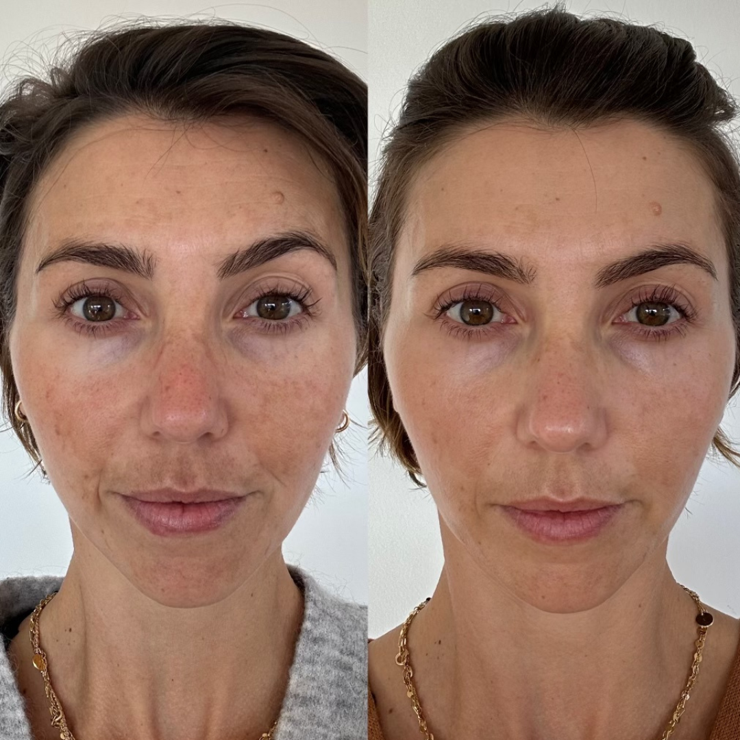 Combo Set – For Melasma, Pigmentation, and Dark Spots Gone!