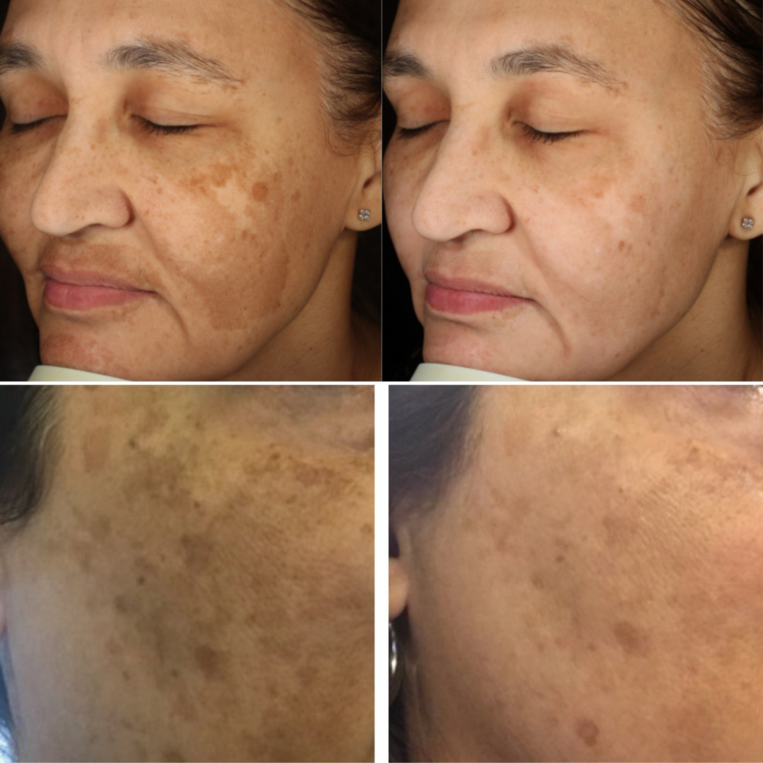 Combo Set – For Melasma, Pigmentation, and Dark Spots Gone!