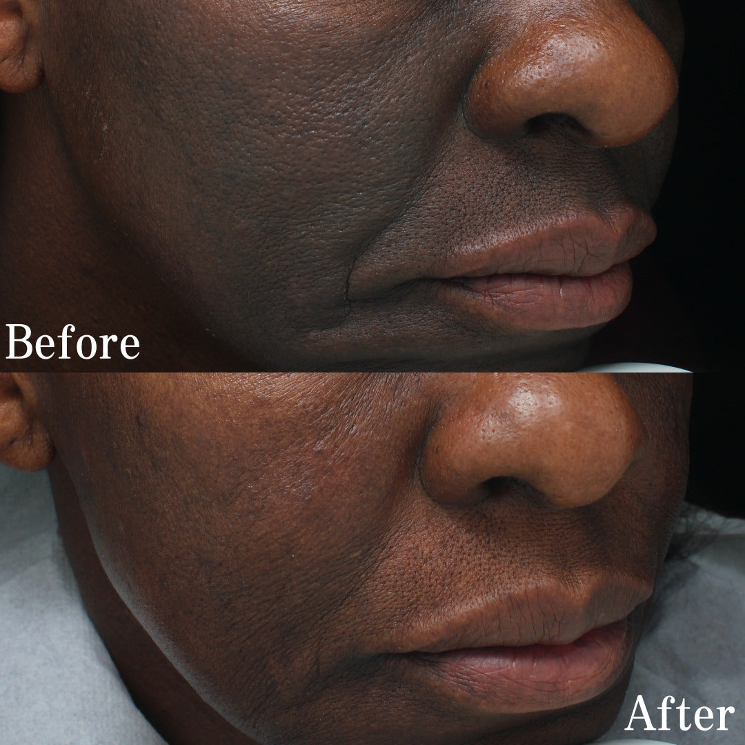 Combo Set – For Melasma, Pigmentation, and Dark Spots Gone!