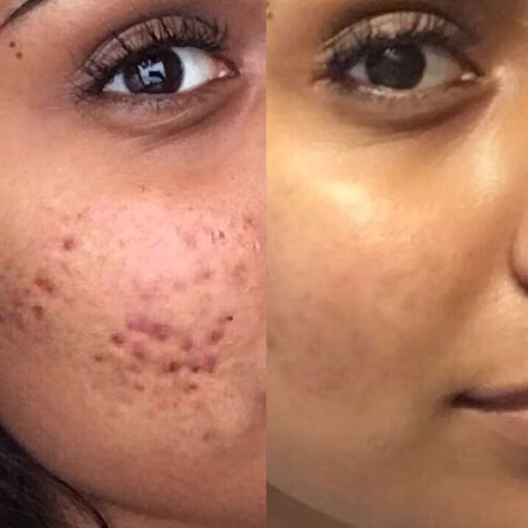 Combo Set for Oily, Acne-Prone Skin