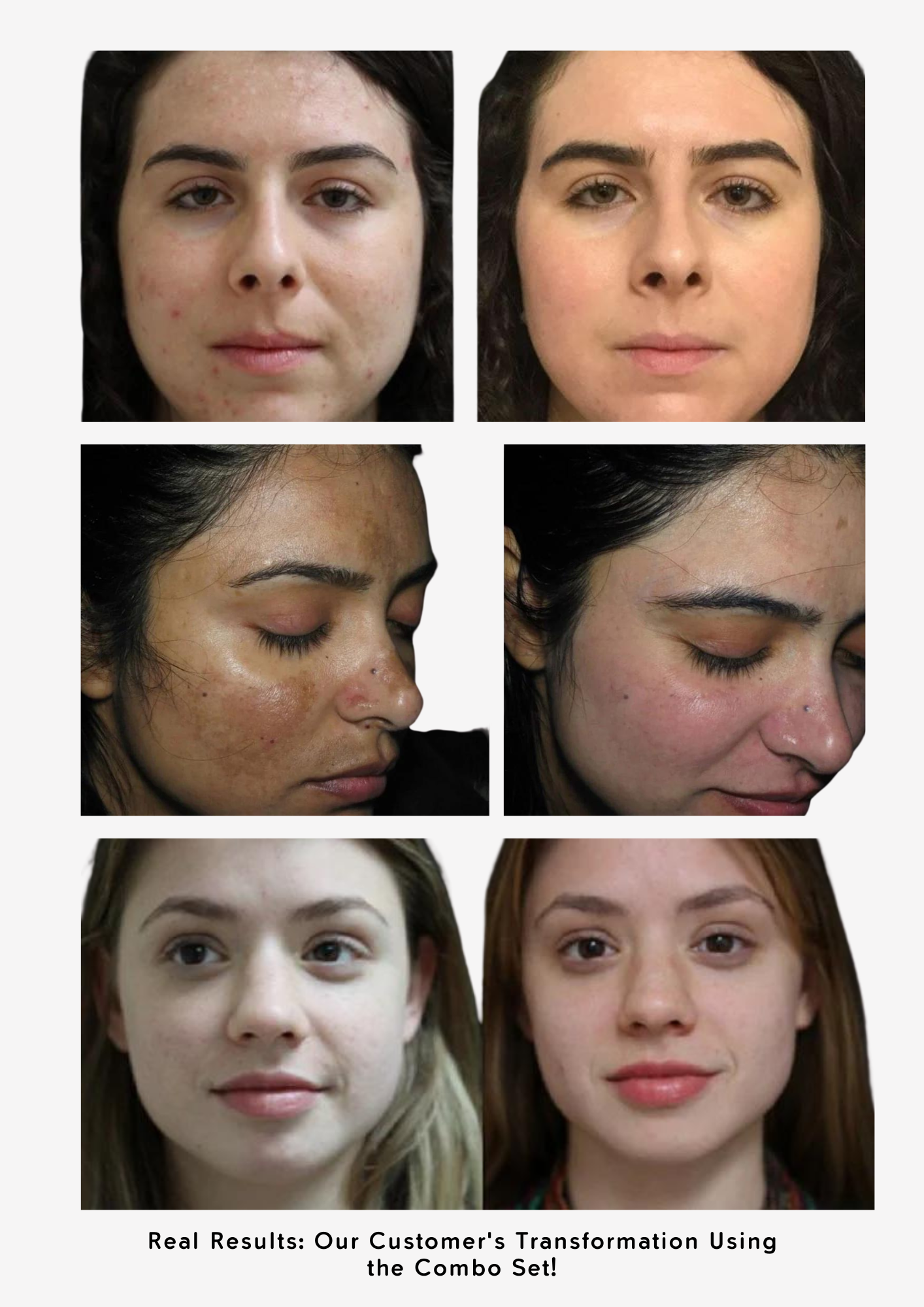 Combo Set – For Melasma, Pigmentation, and Dark Spots Gone!
