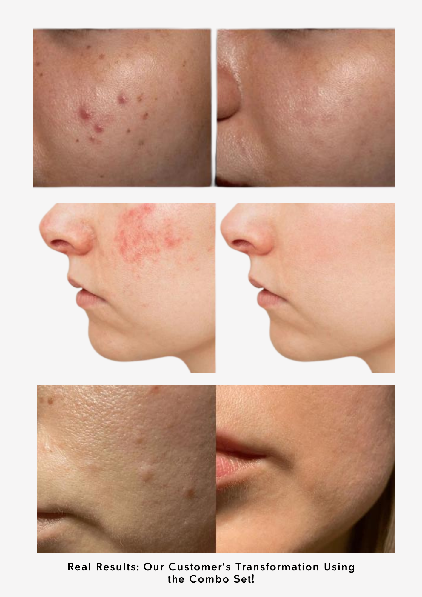Combo Set for Oily, Acne-Prone Skin